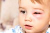 Các bệnh mắt thường gặp ở trẻ bố mẹ nên biết